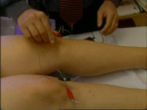 What Happens During an Acupuncture Session?