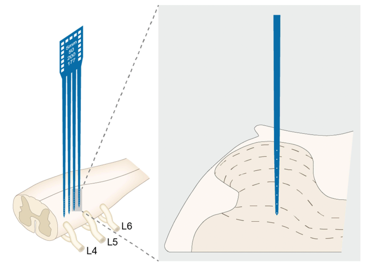 Pre-EA on spinal WDRs – The BMAS Blog