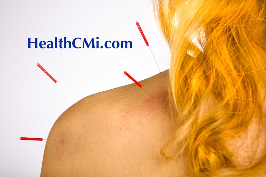 Acupuncture Alleviates Shoulder Pain