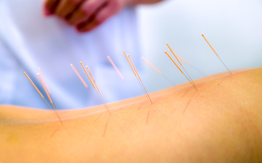 Acupuncture Fibromyalgia Research Success Reported