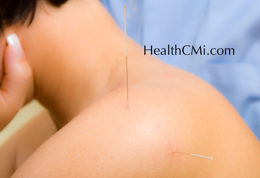 Acupuncture Found Effective For Shoulder Pain Relief