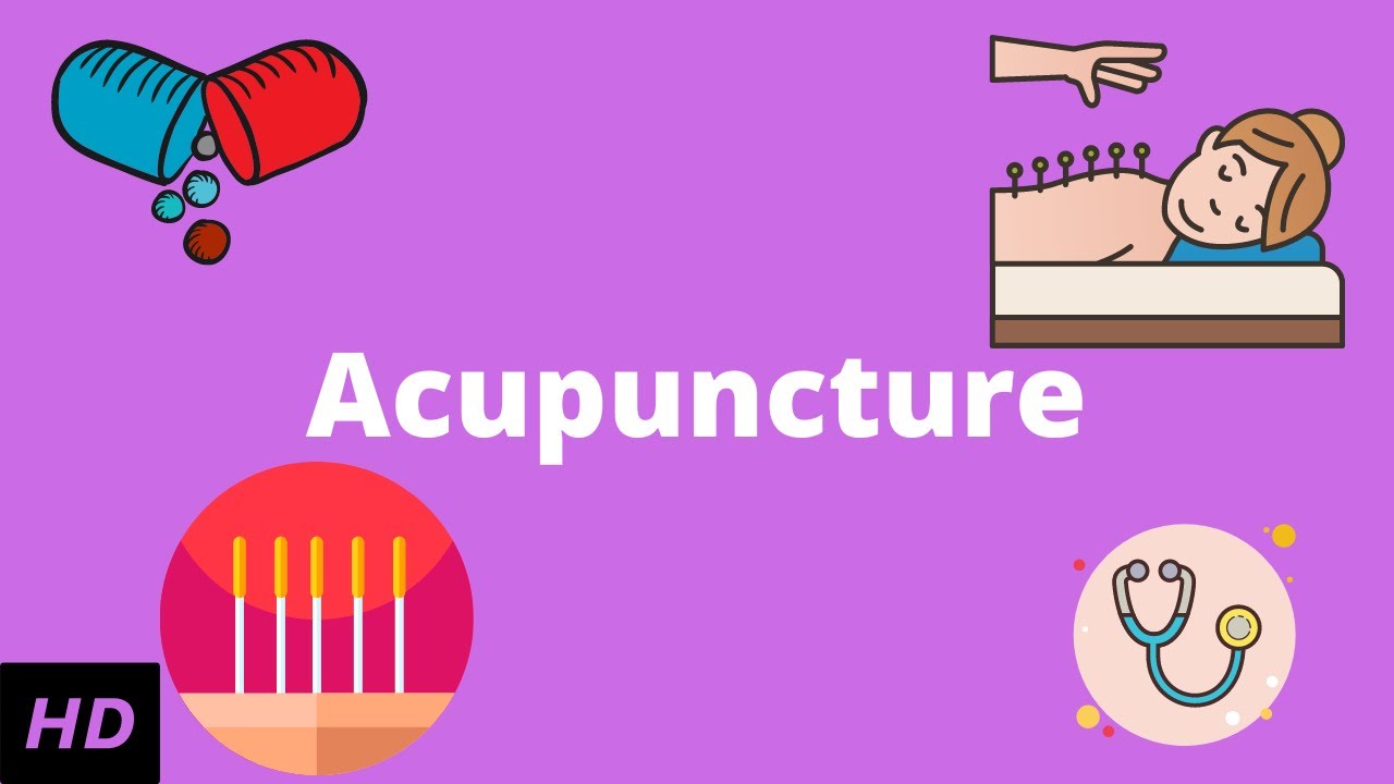 Acupuncture: What You Need to Know