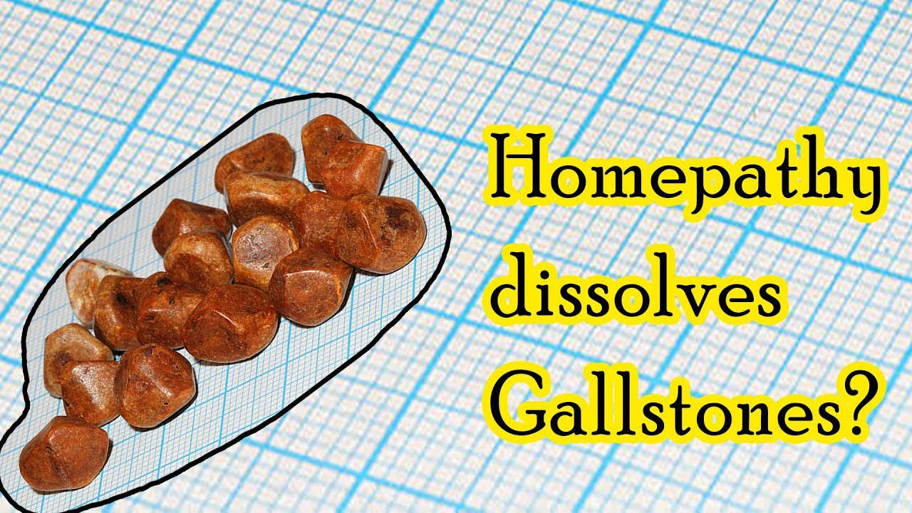 Can homeopathic medicine dissolve gallstones? – Dr. Sanjay Panicker