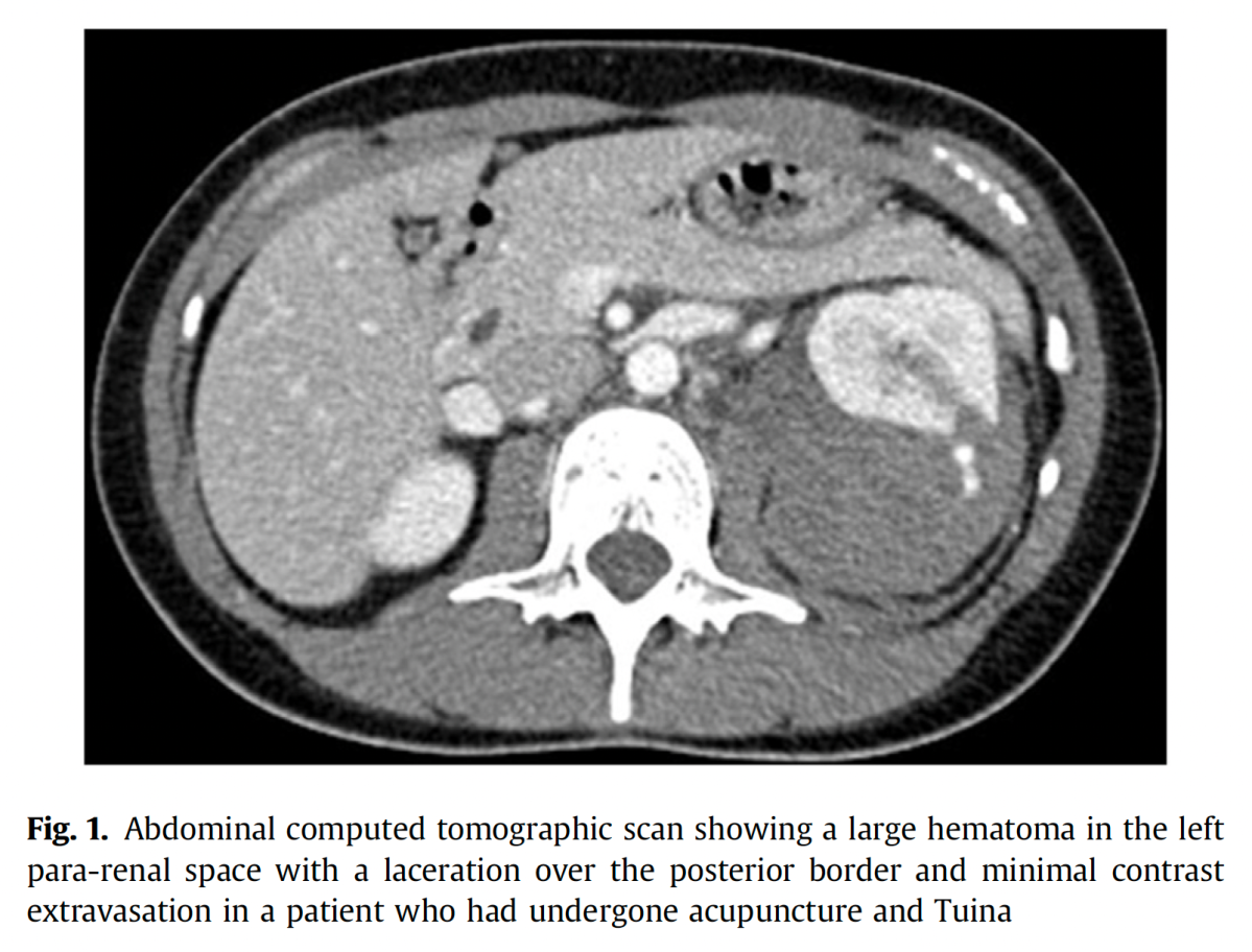 Kidney laceration after acupuncture 2023 – The BMAS Blog