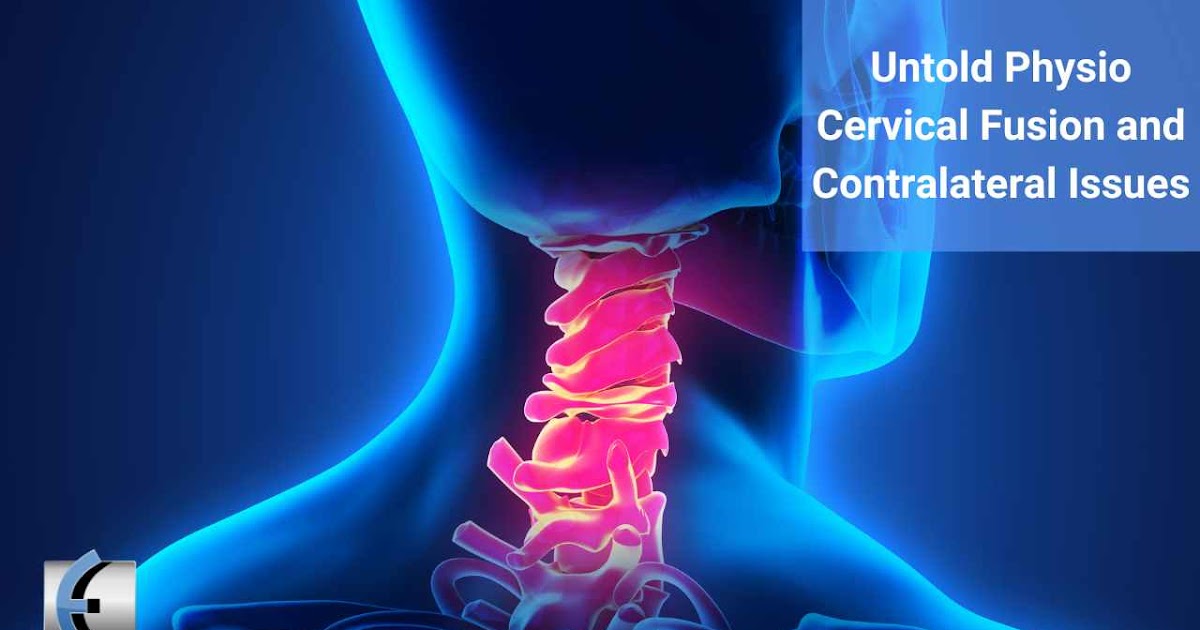 Untold Physio Stories – Cervical Fusion and Contralateral Issues | Modern Manual Therapy Blog