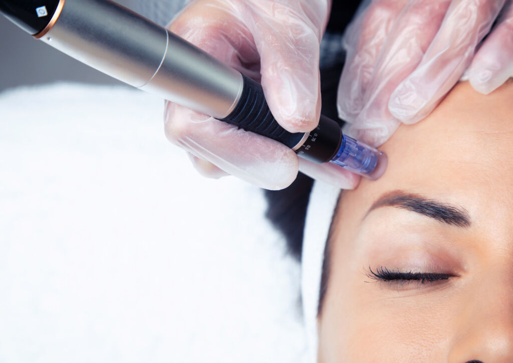 New Micro Needling Research | Jennifer Dubowsky, DIPL.Ac.