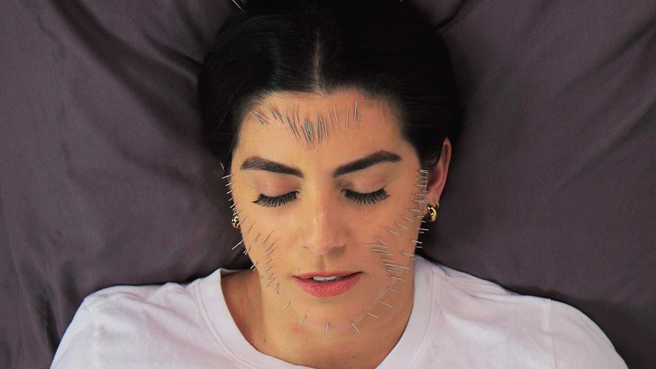 WATCH a Facial Acupuncture Treatment with 100 Needles!