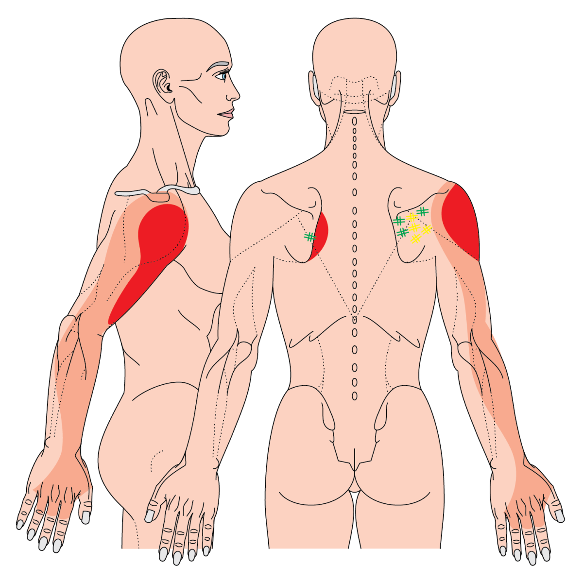 Where to needle 2023 – The BMAS Blog