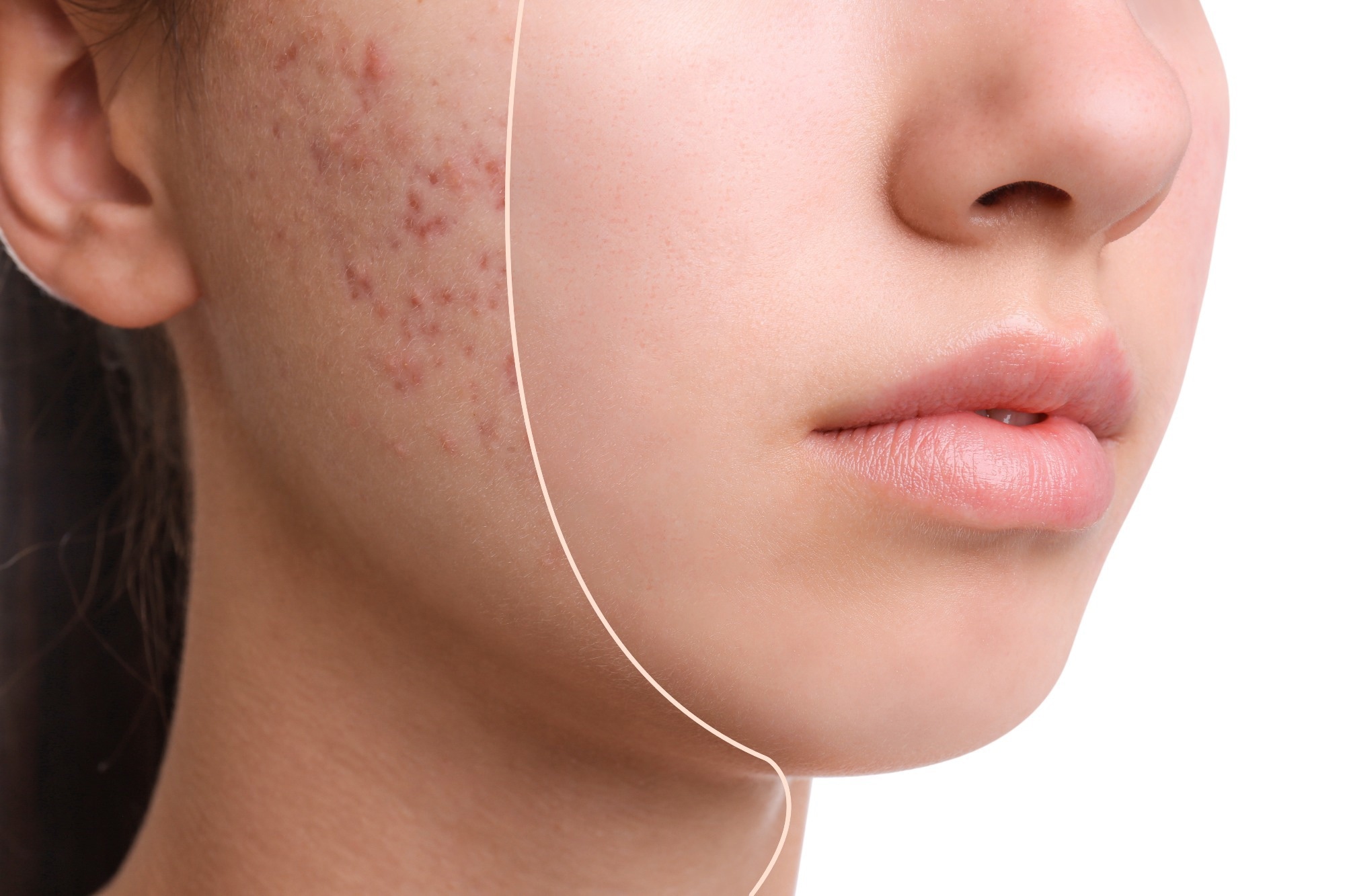 Unique plant extract mixture has potent anti-acne effects