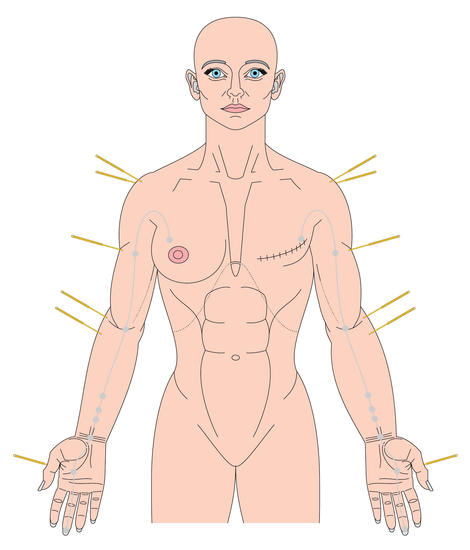 Nerve injury, lymphoedema, and a giant haematoma – The BMAS Blog