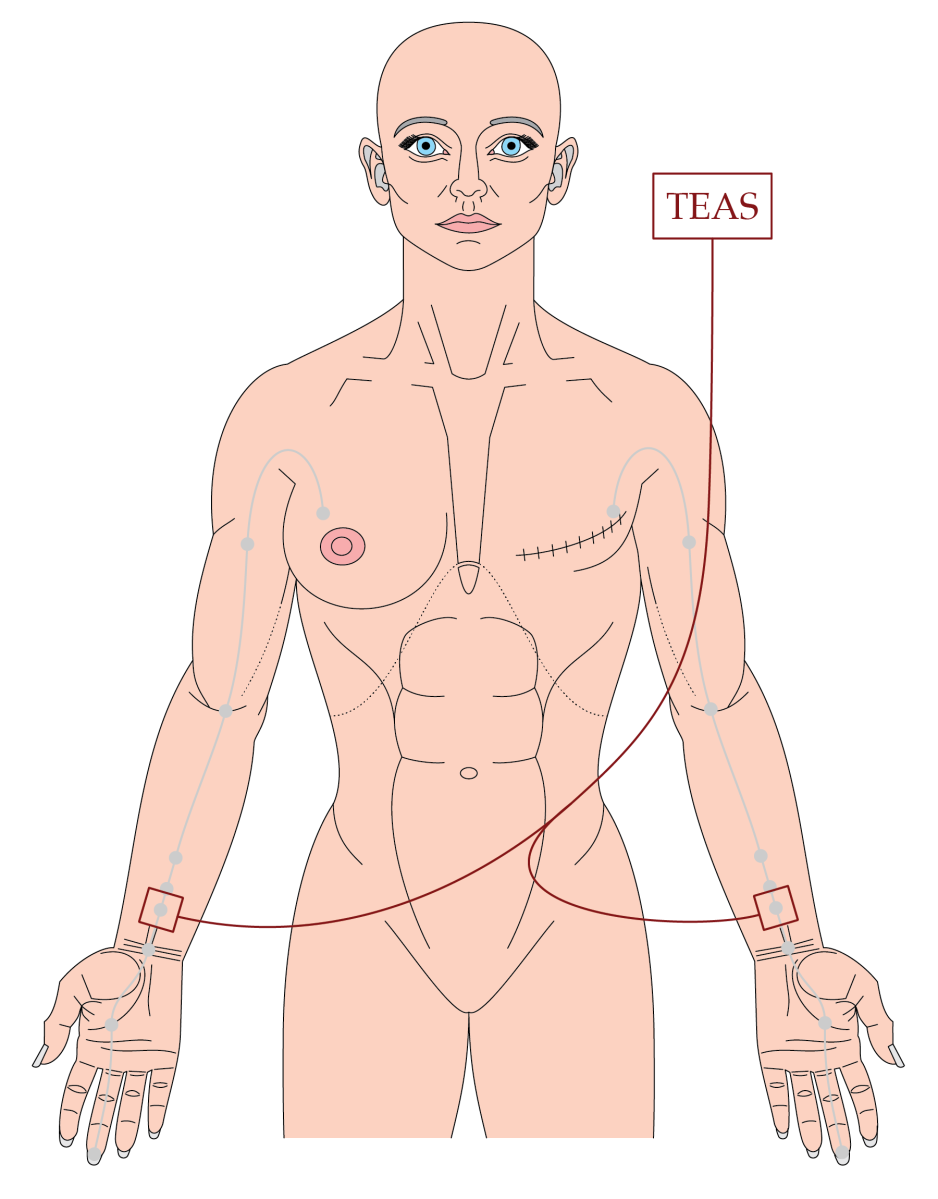 TEAS vs dexamethasone in PONV – The BMAS Blog