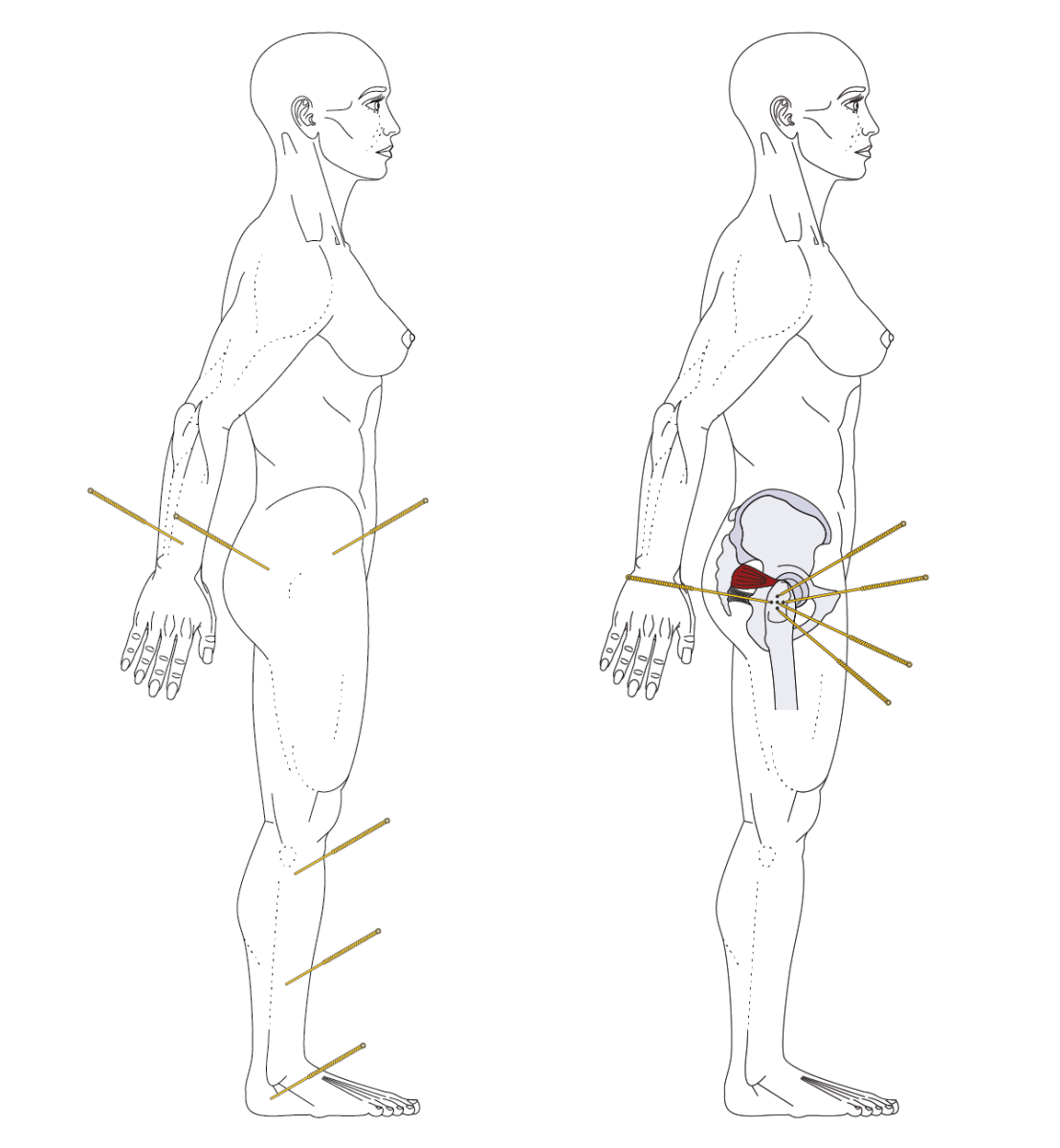 Acupuncture for severe hip OA 2023 – The BMAS Blog