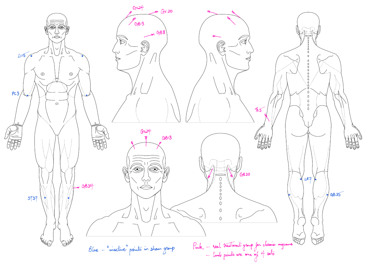 Acupuncture versus topiramate in chronic migraine 2024 – The BMAS Blog