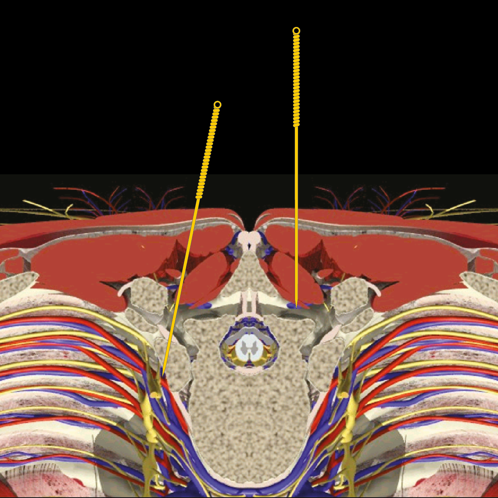 Acupuncture AE at Huatuojiaji – The BMAS Blog