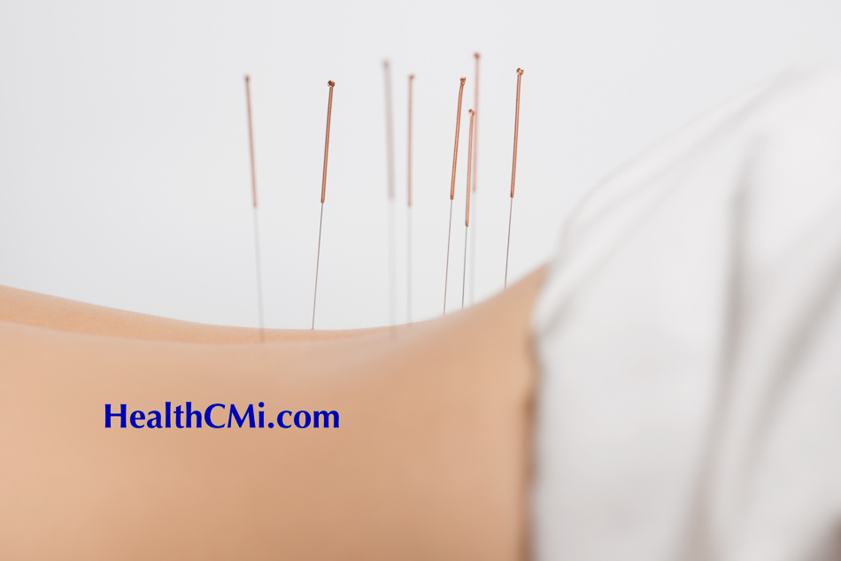 Acupuncture Efficacy in Pain and Mental Health Management