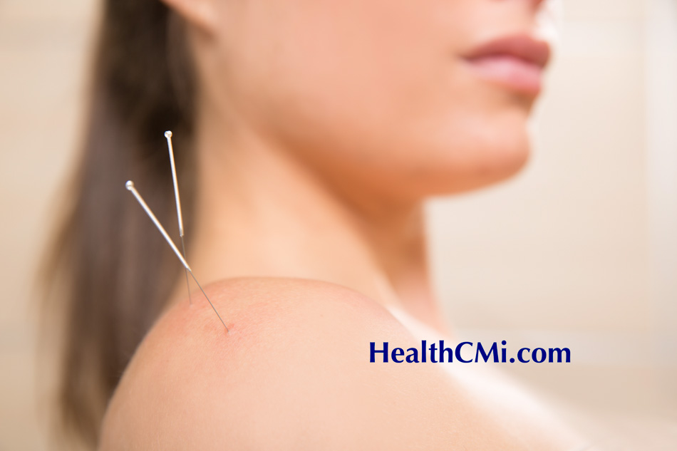 Acupuncture For Shoulder Pain Produces Results