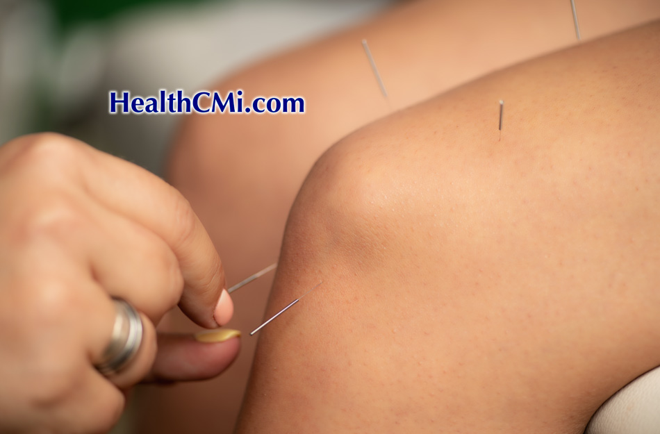 Acupuncture Frontiers in Knee Osteoarthritis Treatment