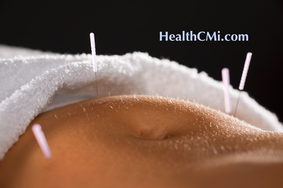 New Study Confirms Acupuncture’s Efficacy in Managing Endometriosis Pain