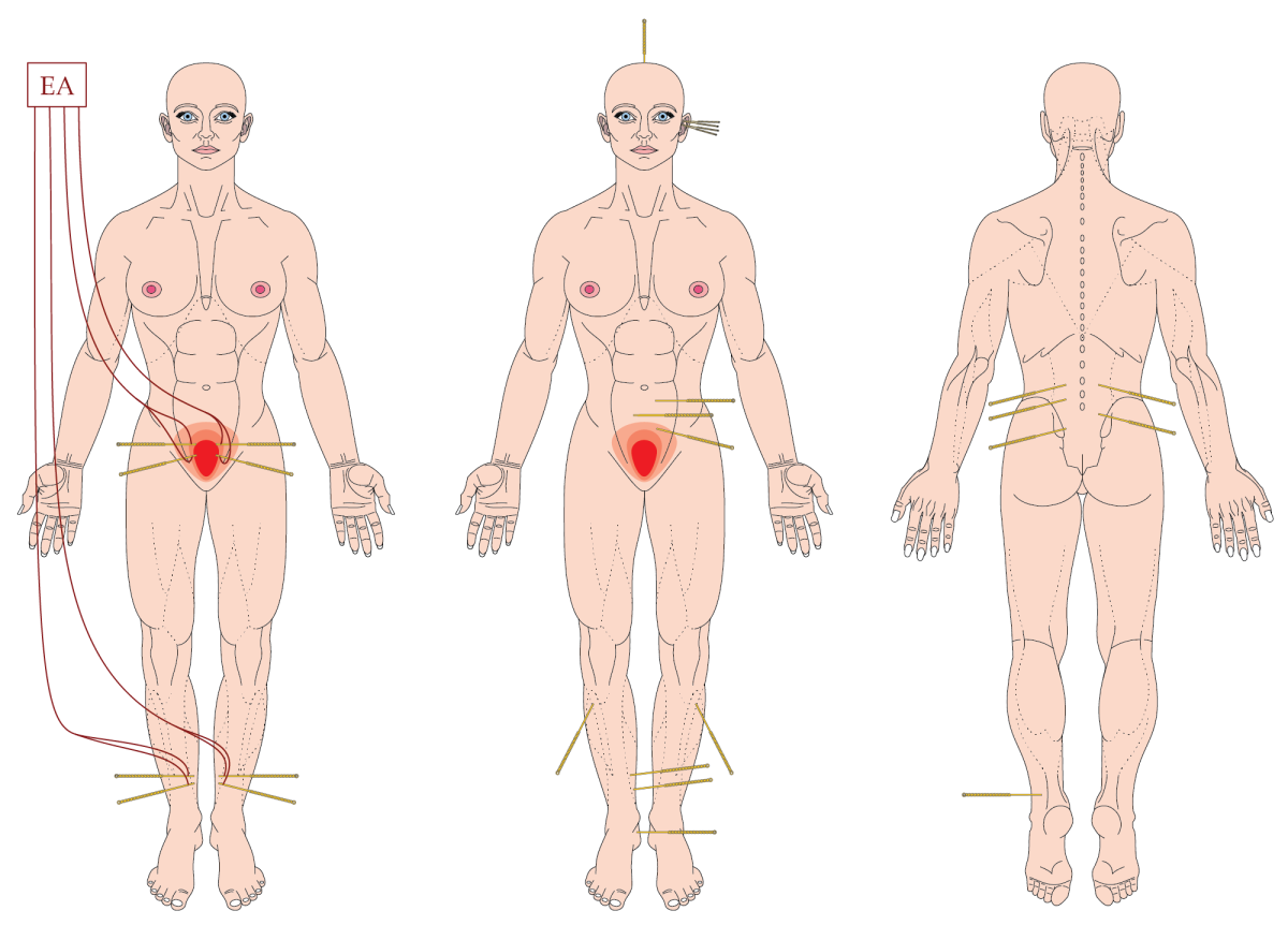 Segmental acupuncture for rUTI 2024 – The BMAS Blog