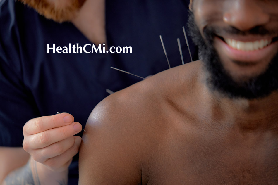 The Athlete’s Edge: Acupuncture is Transforming Sports