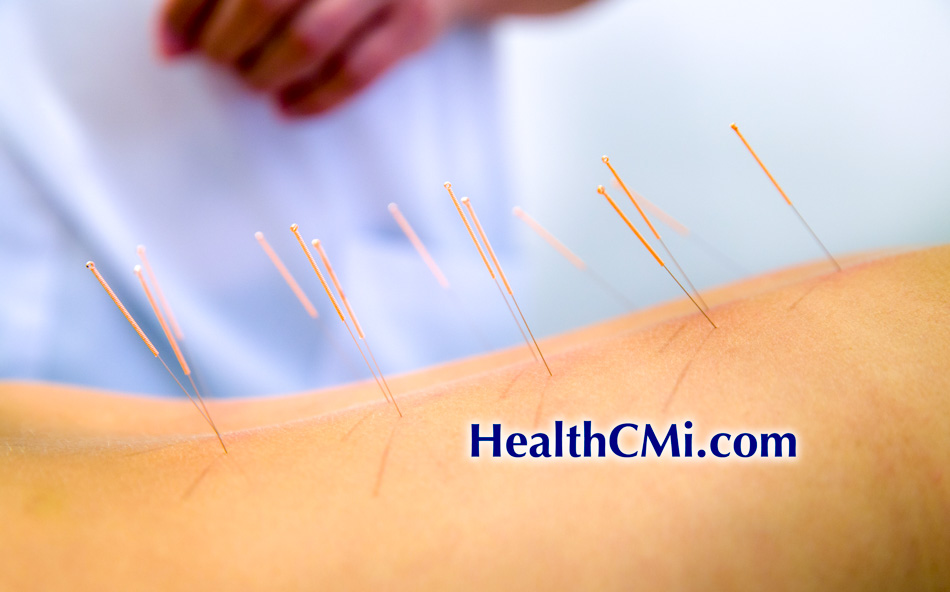 Electroacupuncture Results in Treating Chronic Fatigue Syndrome