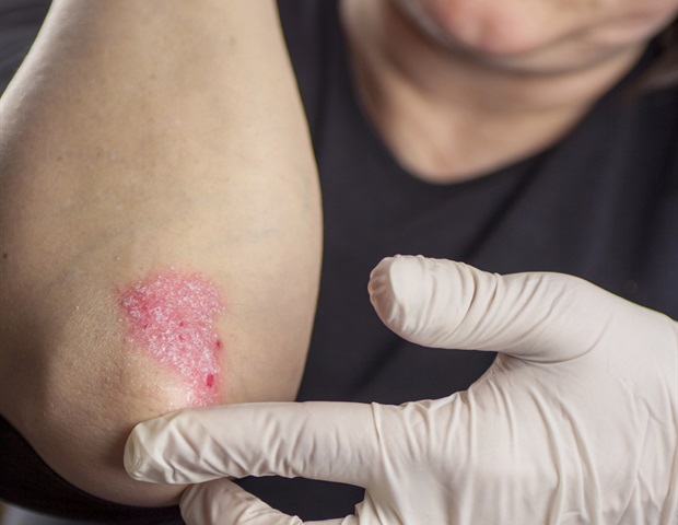 Hormone hepcidin identified as potential trigger for psoriasis