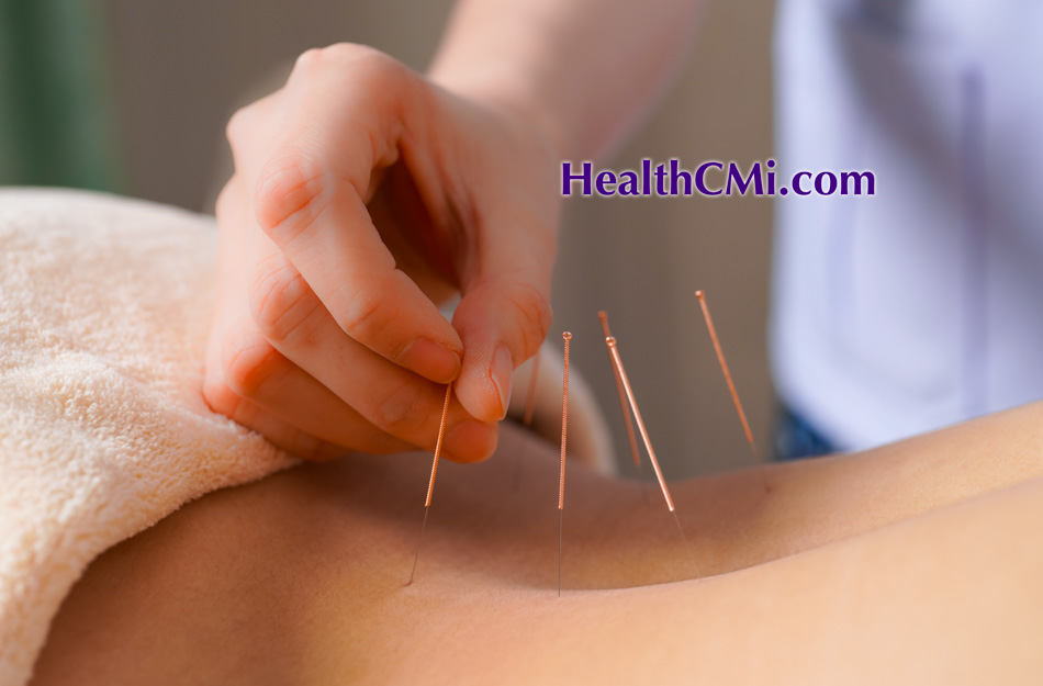 Acupuncture Manages Low Back Pain