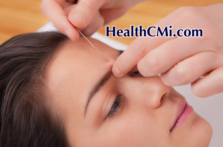 Acupuncture Proves Effective in Migraine Management