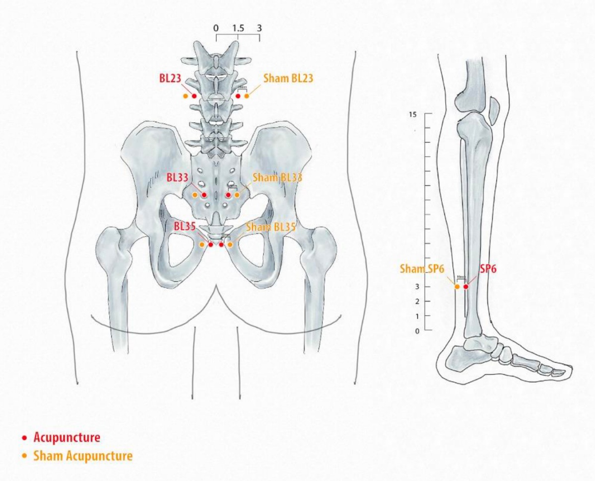 Acupuncture for CP CPPS in drinkers – The BMAS Blog