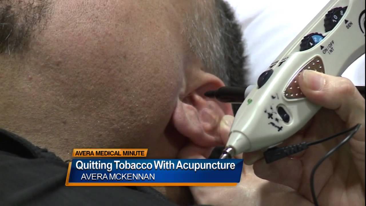 Using Acupuncture to Finally Quit Tobacco – Medical Minute