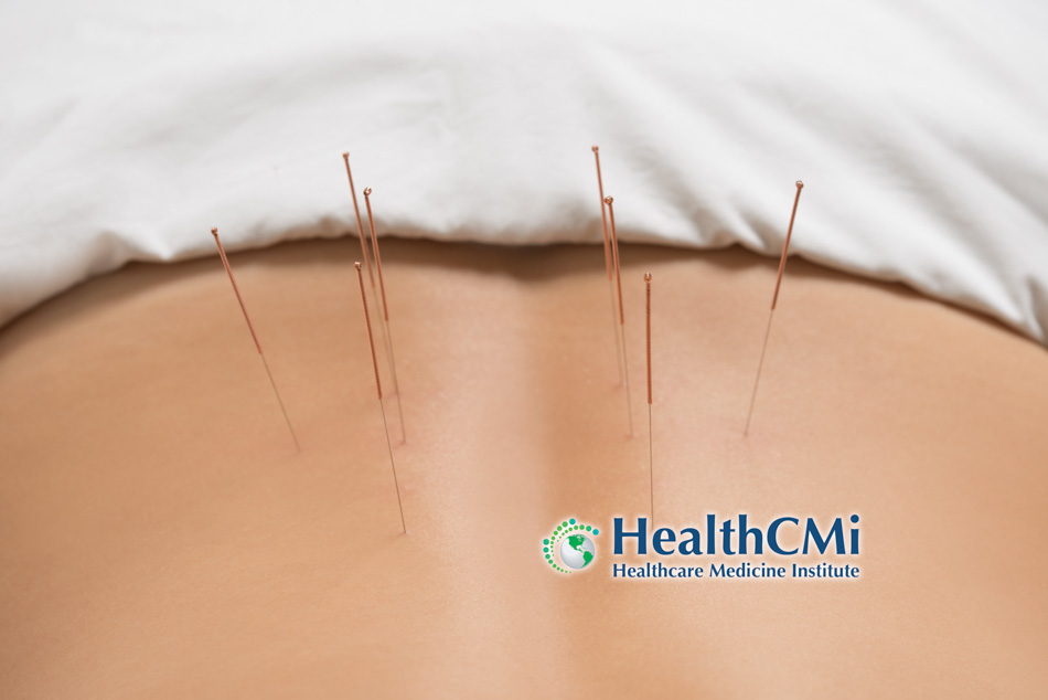 Precision Acupuncture Shows Powerful Results for Low Back Pain Relief